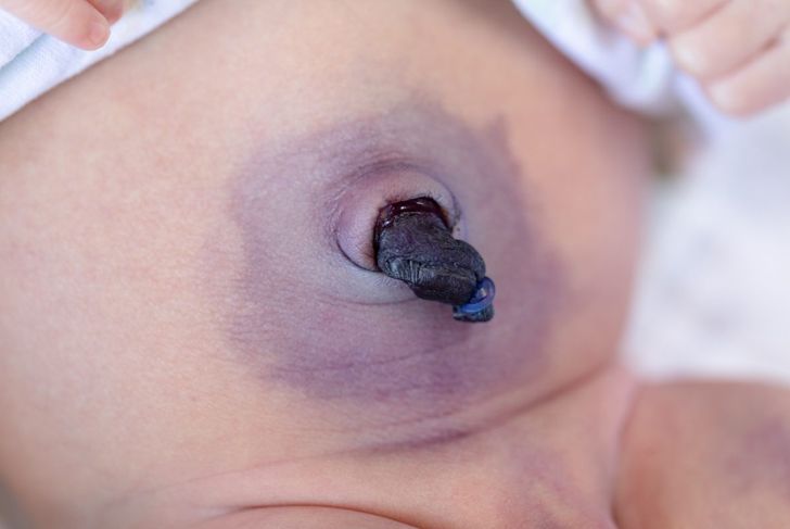 Belly Button Infections In Infants
