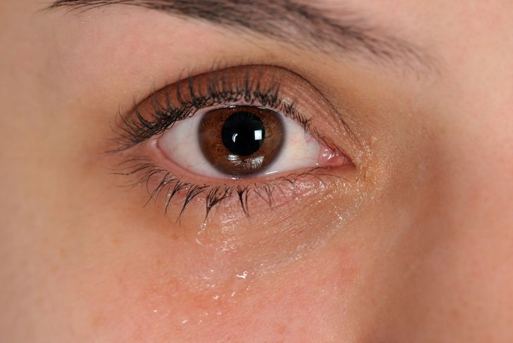 Blocked Tear Ducts: Cause & Treatments