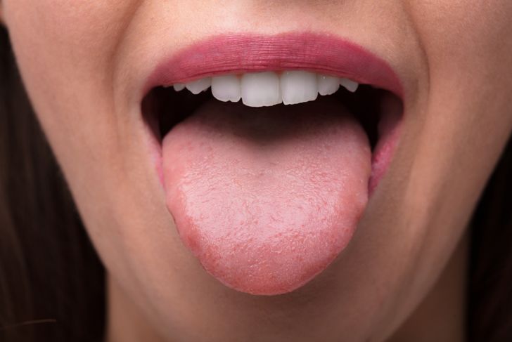 Bumps on the Tongue: Transient Lingual Papillitis