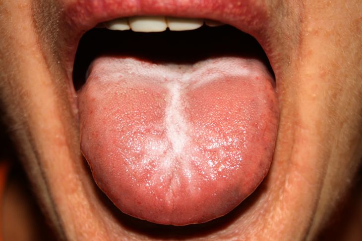 Causes and Solutions for a White Tongue