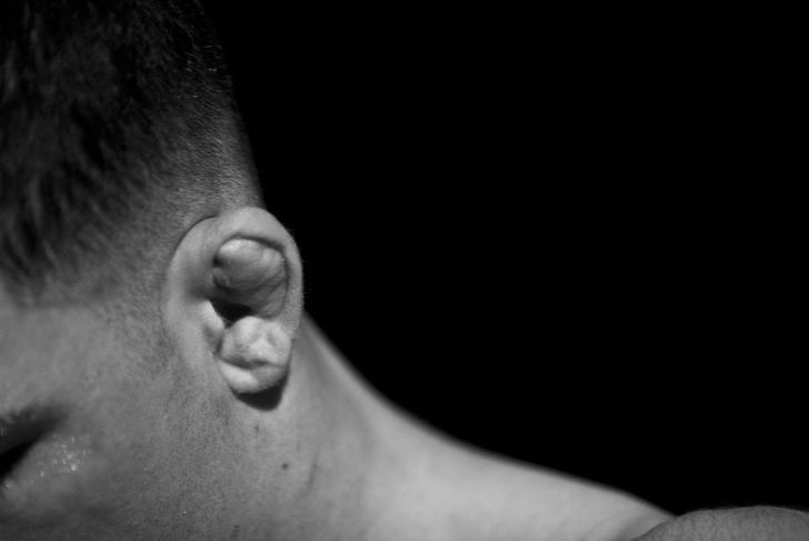 Causes and Treatments for Cauliflower Ear