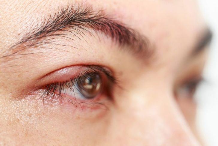 Causes and Treatments of Eye Discharge