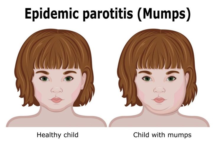 Causes and Treatments of Mumps