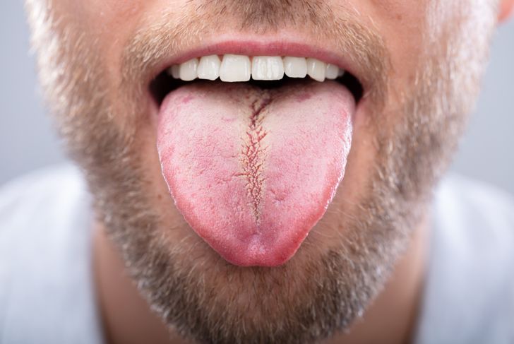 Causes, Effects, and Signs of Fissured Tongue