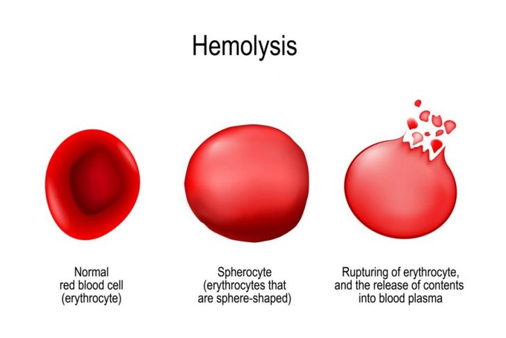 Causes of High and Low Hemoglobin Levels