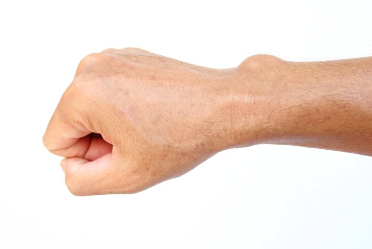 Causes, Symptoms, and Treatments for Ganglion Cysts