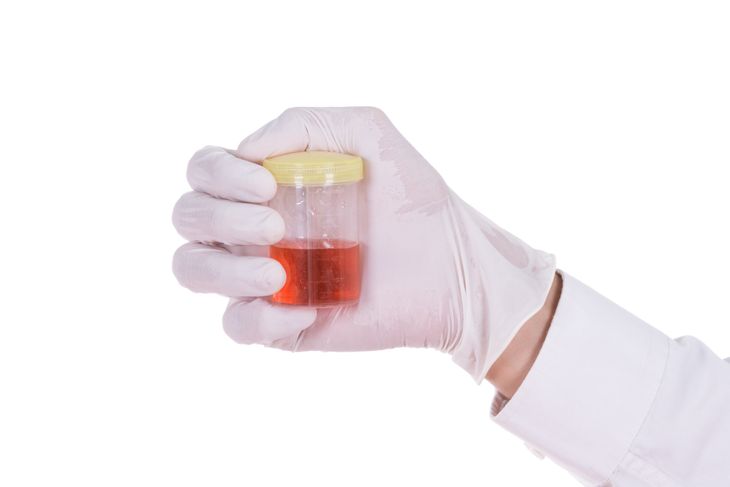 Causes, Symptoms, and Treatments of Cloudy Urine