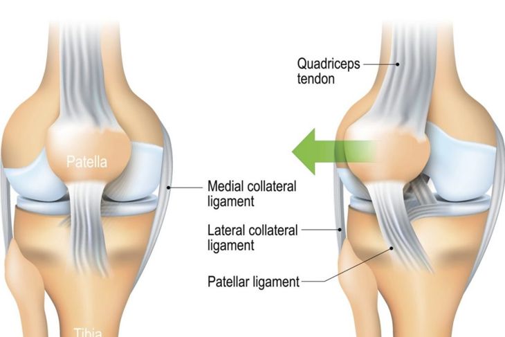 Causes, Symptoms, and Treatments of Patellar Dislocation