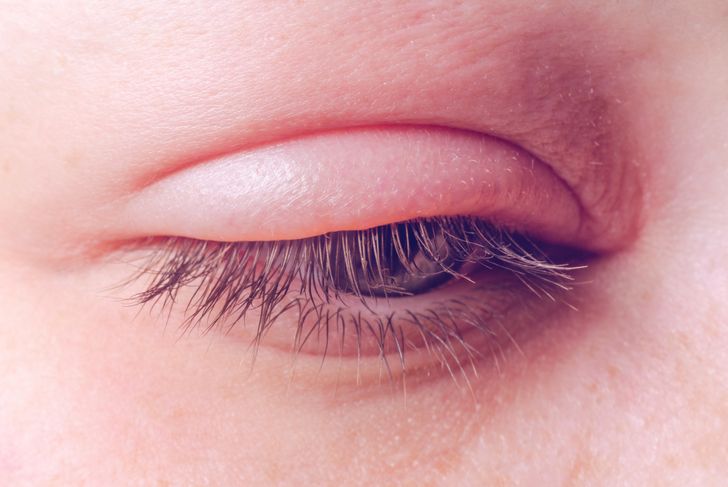 Common Eye Infections and How to Treat Them