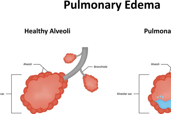 Common Questions Regarding Pulmonary Edemas