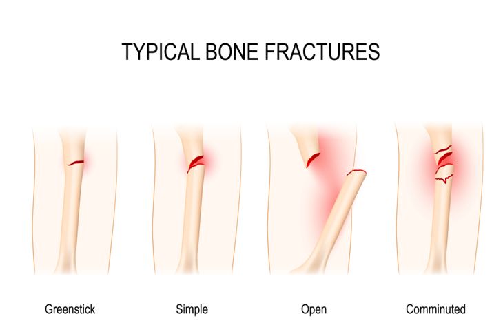 Common Types of Fractures