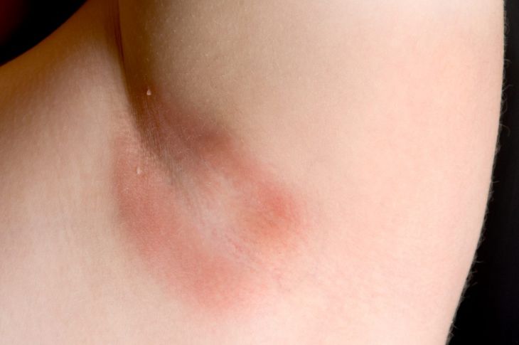 Cutaneous Candidiasis Skin Infection