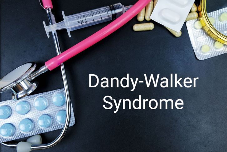 Dandy-Walker Syndrome: A Congenital Brain Malformation
