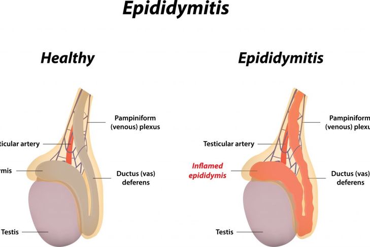 Dealing with an Epididymal Cyst