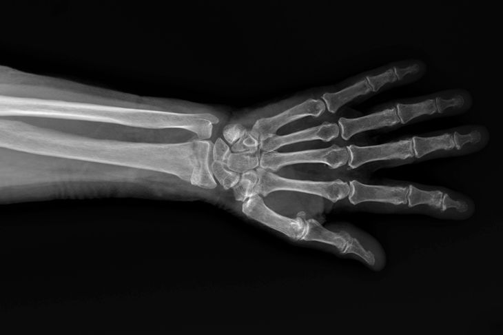 Diagnosing and Treating a Colles Fracture
