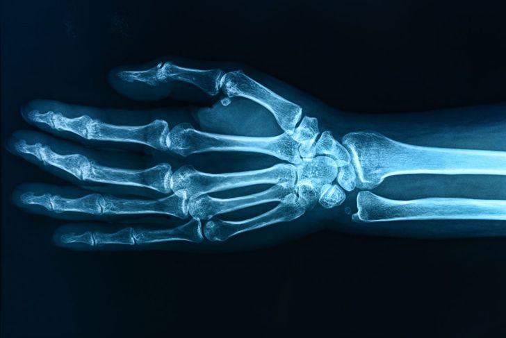 Diagnosing and Treating a Sprained Wrist
