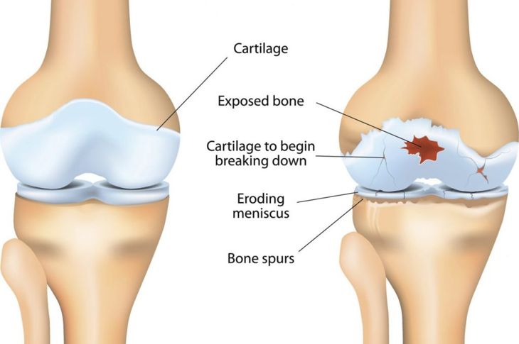 Diagnosing and Treating Osteochondritis Dissecans