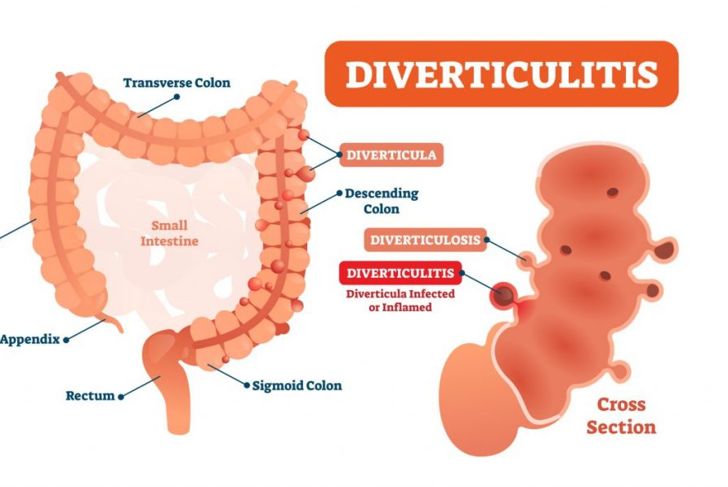 Diverticulitis Treatments