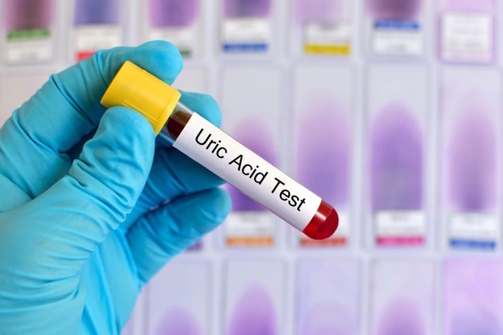 Do You Know Your Uric Acid Level?