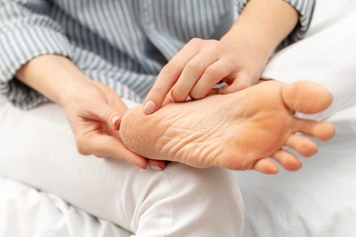 Effective Home Remedies for Cracked Heels and Feet