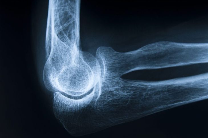 Enthesopathy Causes Tendon or Ligament Pain