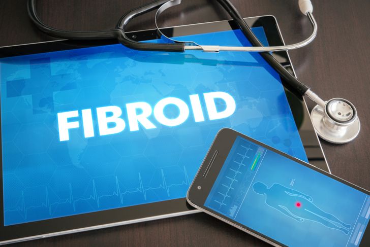 Everything Women Need to Know About Fibroids