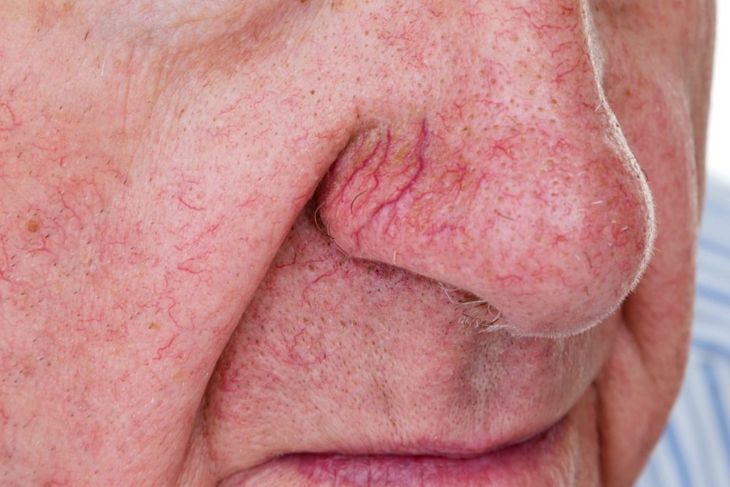 Excessive Swelling of the Nose Could Be Rhinophyma