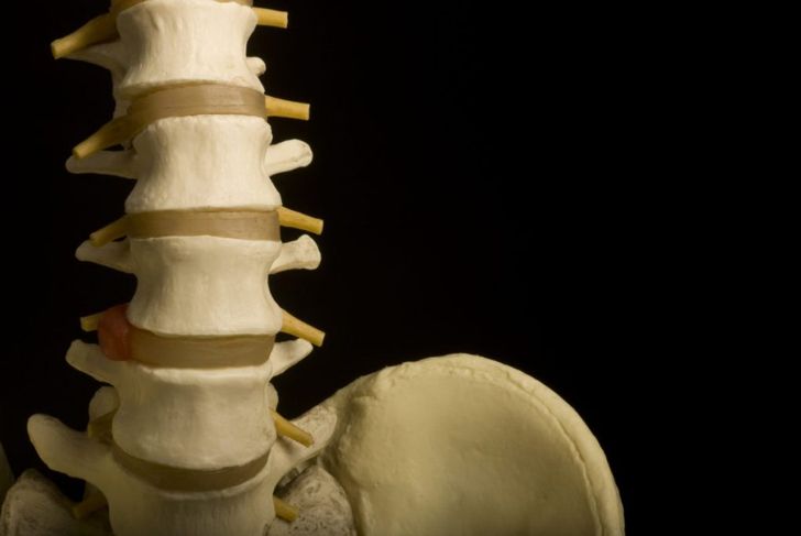 Facet Arthropathy and Spinal Arthritis