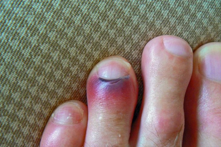 FAQs about a Broken Toe