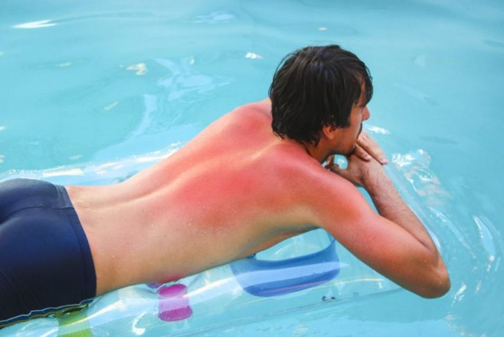 First-Degree Burns: Risks, Symptoms, and Treatment