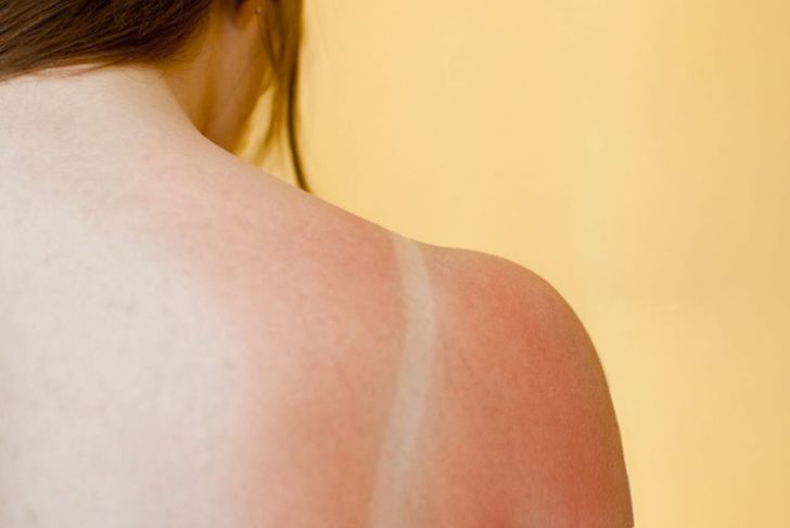 First-Degree Burns: Risks, Symptoms, and Treatment