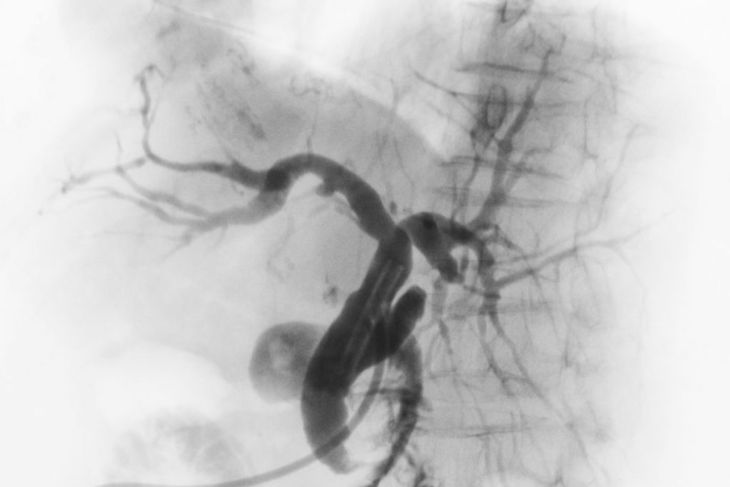 Frequently Asked Questions About Angiograms