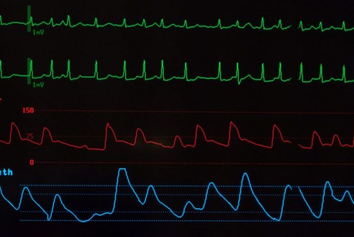 Frequently Asked Questions About Atrial Flutter