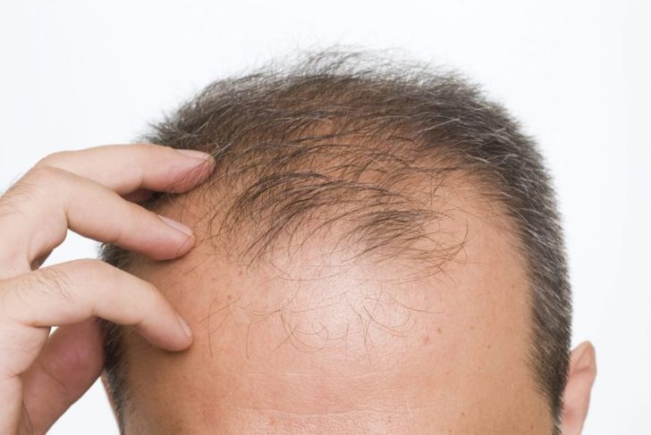Frequently Asked Questions About Diffuse Hair Loss