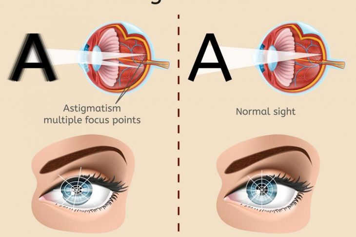 Frequently Asked Questions about Diplopia or Double Vision