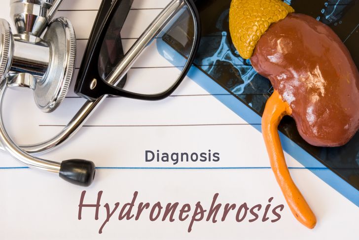 Frequently Asked Questions About Hydronephrosis