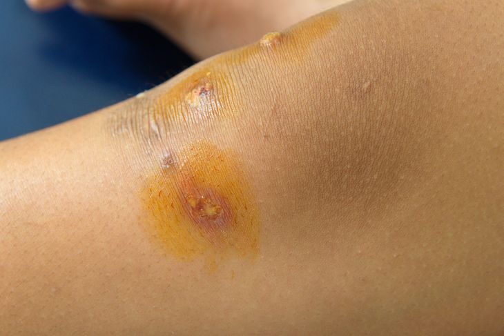Frequently Asked Questions about Impetigo