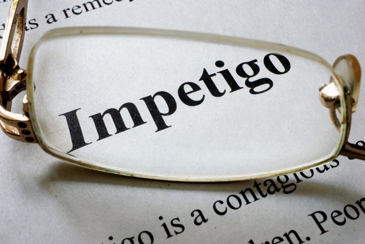Frequently Asked Questions about Impetigo