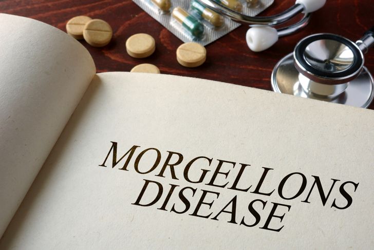 Frequently Asked Questions about Morgellons Disease