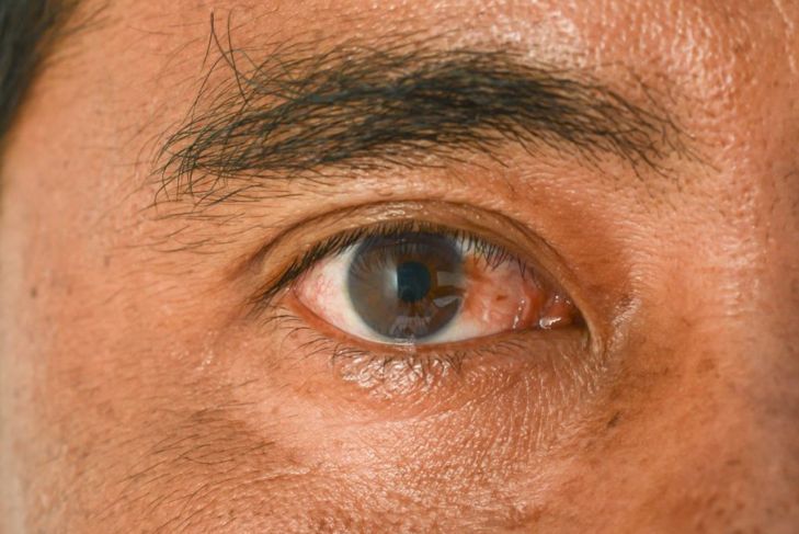 Frequently Asked Questions About Pterygium