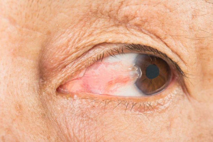 Frequently Asked Questions About Pterygium