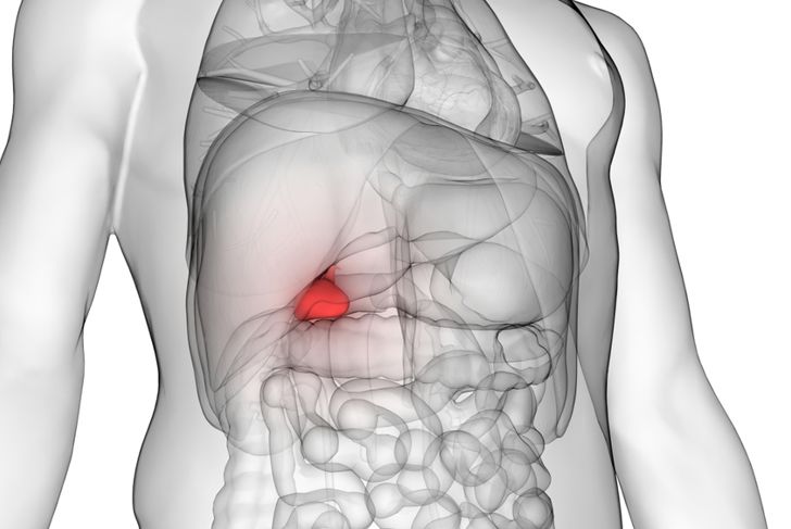 Gallbladder Sludge and Its Relation to Gallstones