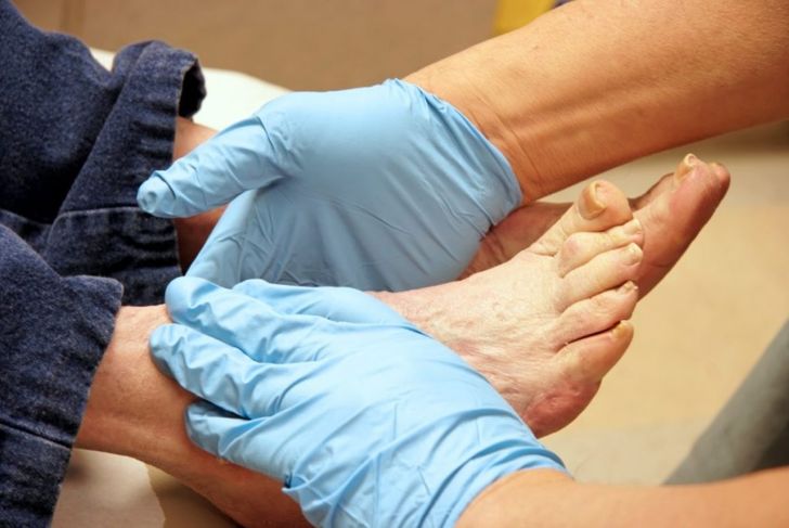 Hammer Toe: What It Is and How To Treat It