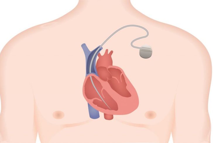 How Do Pacemakers Work?