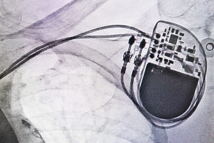 How Do Pacemakers Work?
