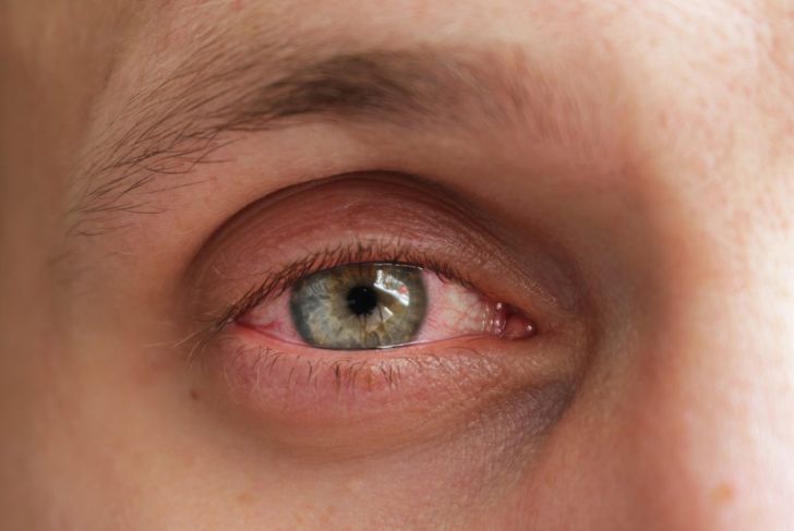 How Does Pink Eye Spread?
