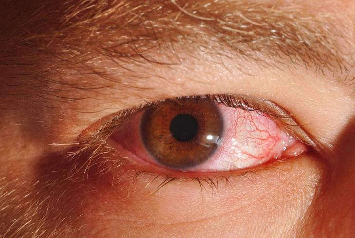 How Does Pink Eye Spread?
