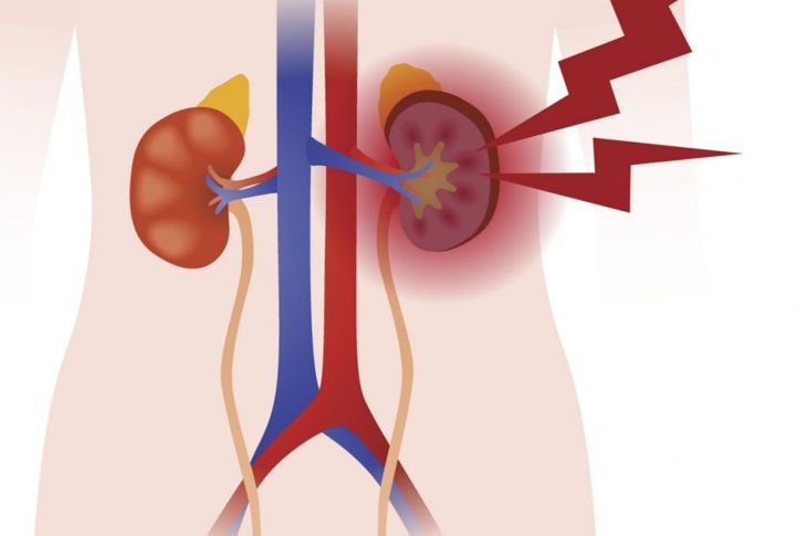 How Primary Aldosteronism Affects the Heart and Kidneys