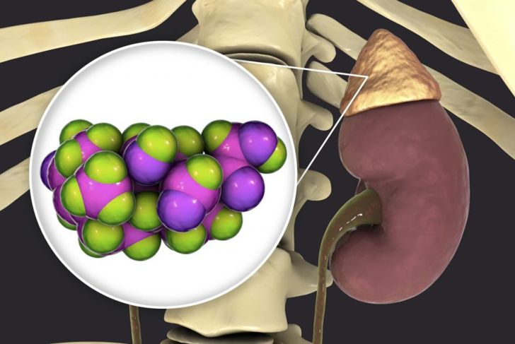How Primary Aldosteronism Affects the Heart and Kidneys