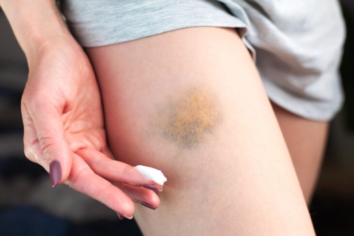 How to Get Rid of Bruises Faster